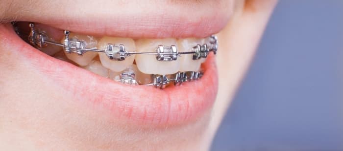 Do I need orthodontics or teeth braces? 3 points to check
