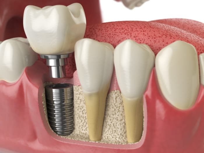 Differences between traditional vs non-invasive dental implant techniques?