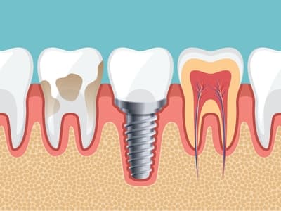 Crowns Explained: How a Dental Crown Caps a Tooth (Hong Kong Patient Guide)