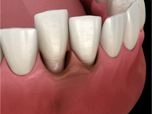 How to repair Gum Recession with Gum Recovering Surgery in Hong Kong?