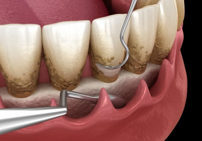Non-Surgical Periodontal Treatment: What It Treats and What to Expect