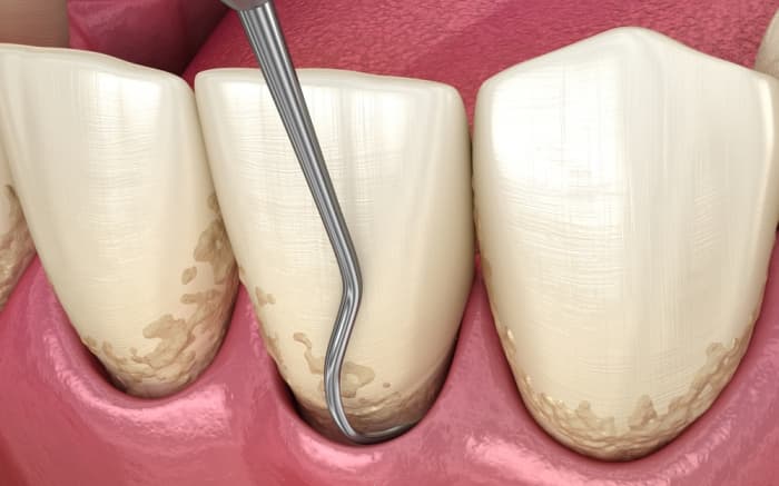 Non-Surgical Periodontal Treatment: What It Treats and What to Expect