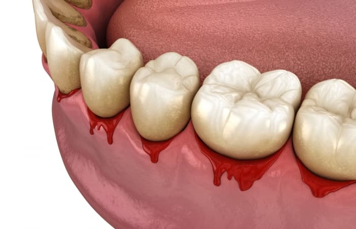 Periodontal Surgery in Hong Kong: When Gum Bleeding Signals Advanced Disease