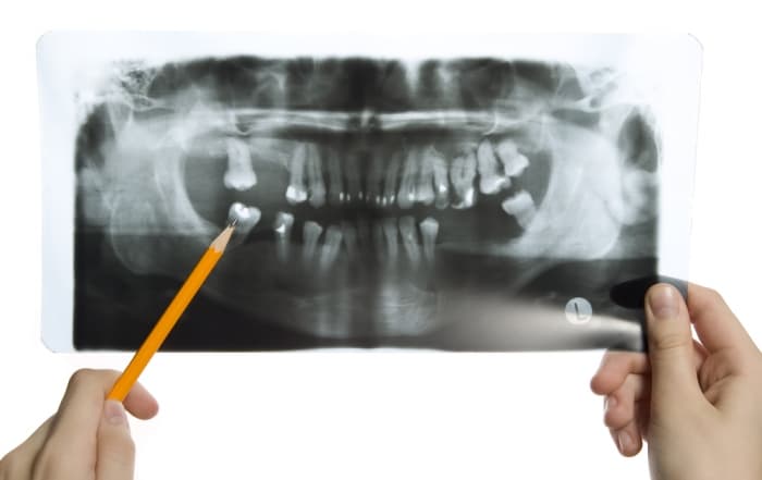 Periodontal Surgery in Hong Kong: When Gum Bleeding Signals Advanced Disease