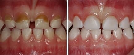 Differences between the crown of primary and permanent teeth after root canal treatment.