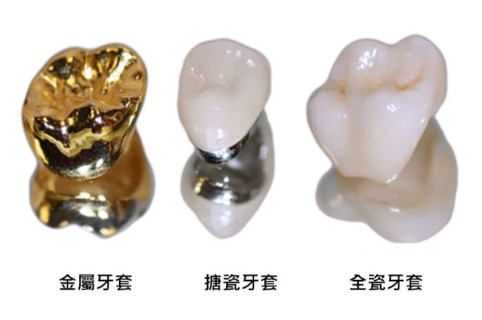 牙套
