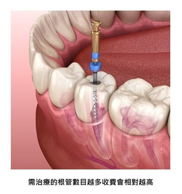 root canal treatment cost
