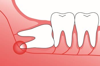 cost of extracting wisdom teeth