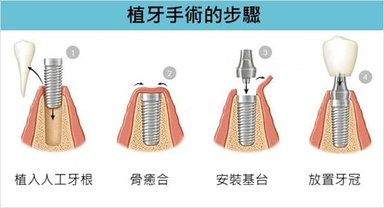種牙手術