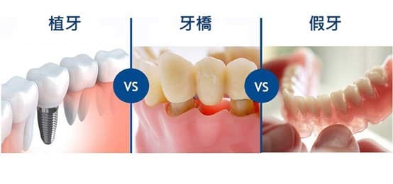牙橋治療對比