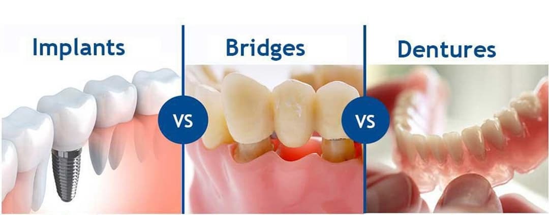 Missing a Tooth? How Dental Bridges Work and Whether They Suit You