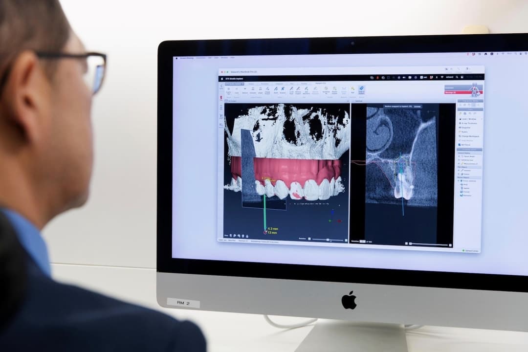 Hong Kong Dental Implants: Treatment at Home vs Abroad—What to Compare