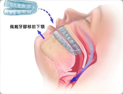 CPAP Isn't the Sole Option! Explore Dental Solutions to Improve Sleep Apnea