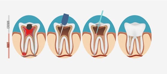 Five Keys to Successful Root Canal Treatment in Hong Kong: Quality of Care and Follow-Up