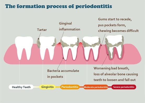 Process of periodontitis