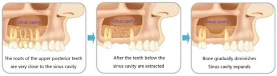 implant