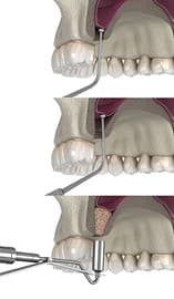 Understanding How Sinus Lift Surgery Helps with Implants