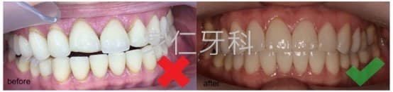  Alt text: 瓷牙貼面修復前後對比圖。左側顯示修復前的情況，瓷牙貼面安裝不良，導致牙齒排列不整齊和美觀問題；右側顯示修復後的情況，瓷牙貼面安裝良好，牙齒排列整齊，美觀自然。