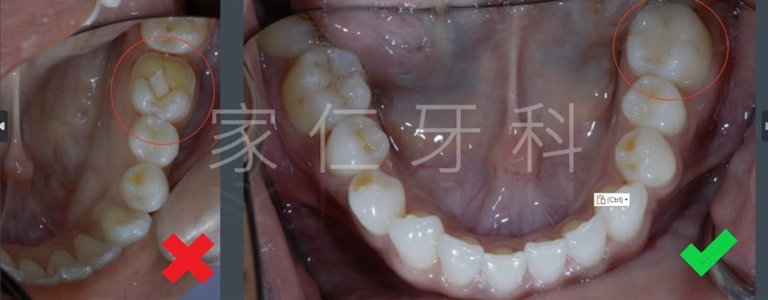 補牙修復前後對比圖。左側顯示修復前的情況，舊的補牙材料破裂，導致牙齒進一步損壞；右側顯示修復後的情況，新的補牙材料安裝良好，牙齒恢復健康和功能。