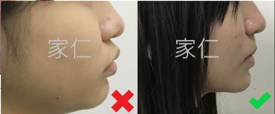 矯正失敗案例導致前牙外傾和前突加劇，修復前後對比圖。左側顯示治療前的情況，前牙明顯外傾，前突問題加劇；右側顯示修復後的情況，前牙位置正常，前突問題得到改善。