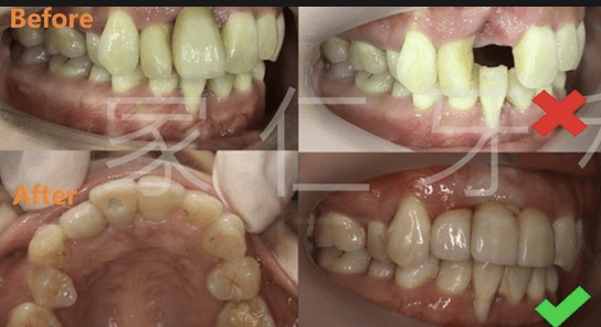 Comparison of pre- and post-treatment. Top left and top right show pre-treatment with improperly positioned implant causing esthetic and functional damage. Bottom left and bottom right show post-treatment with correctly positioned implant, successful restoration, and restoration of chewing function and natural appearance.