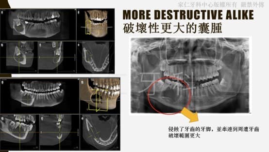 X-ray comparison of more destructive cyst. The left side shows the development of a cyst due to delayed root canal treatment; the right side zooms in on the cyst, highlighting its extensive damage to the tooth and surrounding tissues.