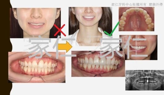 Dental esthetic makeover case, combining veneers, crowns, and implants. The left side shows the condition before treatment with misaligned teeth and an unsatisfactory smile; the right side shows the post-treatment condition with properly aligned and aesthetically pleasing teeth, achieved through veneers, crowns, and implants, resulting in a confident smile.