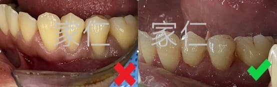 牙齦移植治療前後對比圖：左側顯示治療前的牙齦退縮和黑三角問題，右側顯示經過牙齦移植治療後牙齦恢復健康、牙齒緊密排列的效果，改善了美觀和口腔健康