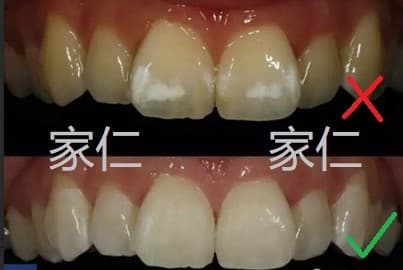 Comparison of ICON treatment for white spots on teeth before and after