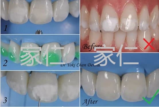 Comparison of ICON treatment for white spots on teeth before and after: showing the initial white spots, surface treatment with acidic solution, application of infiltrant, and final results, significantly improving the appearance of the teeth.