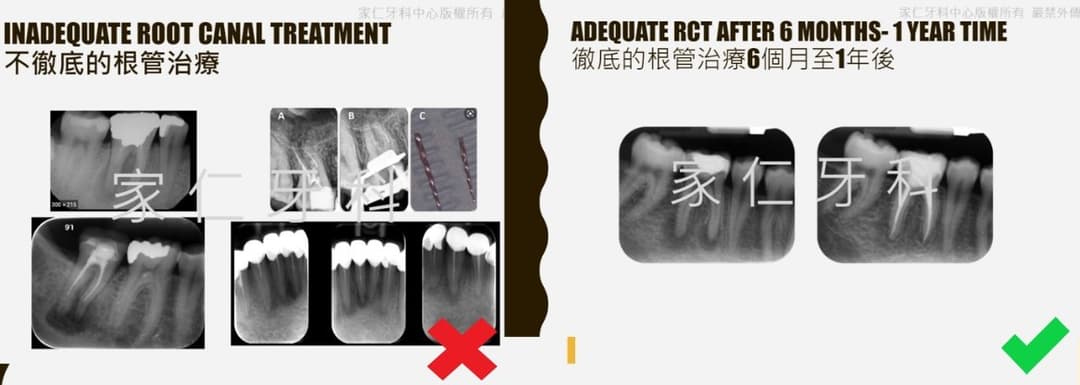 根管治療前後對比圖。左側顯示不徹底的根管治療，導致牙齒持續受損；右側顯示經過6個月至1年後的徹底根管治療，牙齒健康恢復正常。