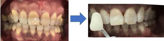 Before and After Treatment with Home Whitening and ICON Resin Infiltration