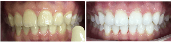 Before and After Teeth Whitening Treatment