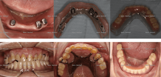 Images show the use of remaining dental roots for magnet connection to secure dentures more stably, aiding in the restoration of function and aesthetics.