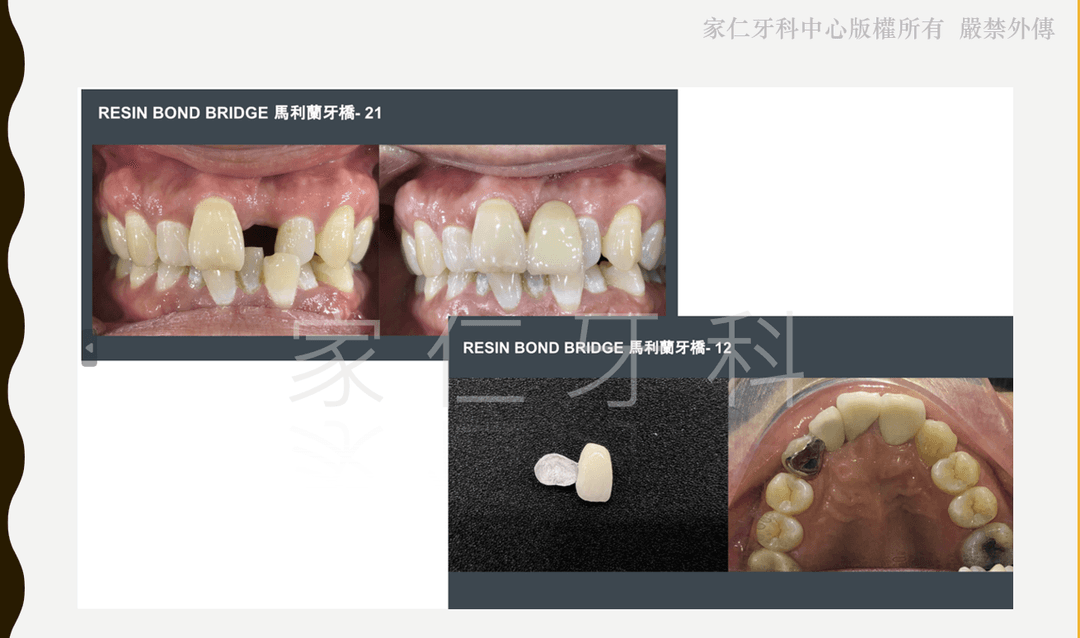 Resin bonded bridge before and after treatment images showing aesthetic improvement in a minimally invasive way