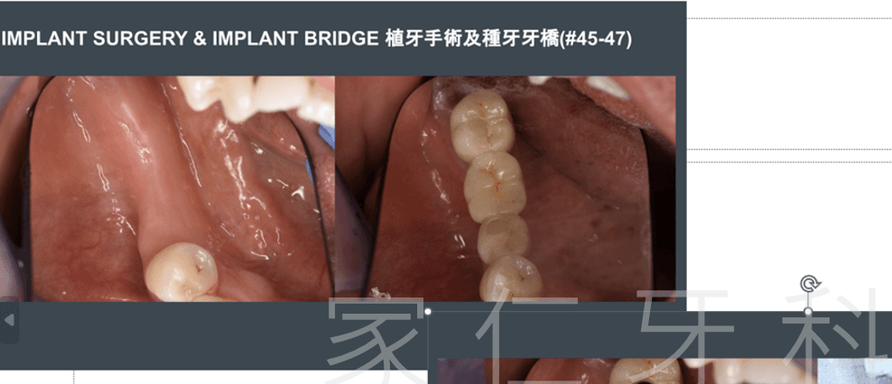 後牙種植牙替換術前術後對比