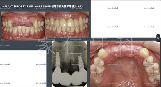 Pre and post-op of implant bridge for anterior teeth for esthetic result, showing the oral condition and esthetic outcome before and after surgery.