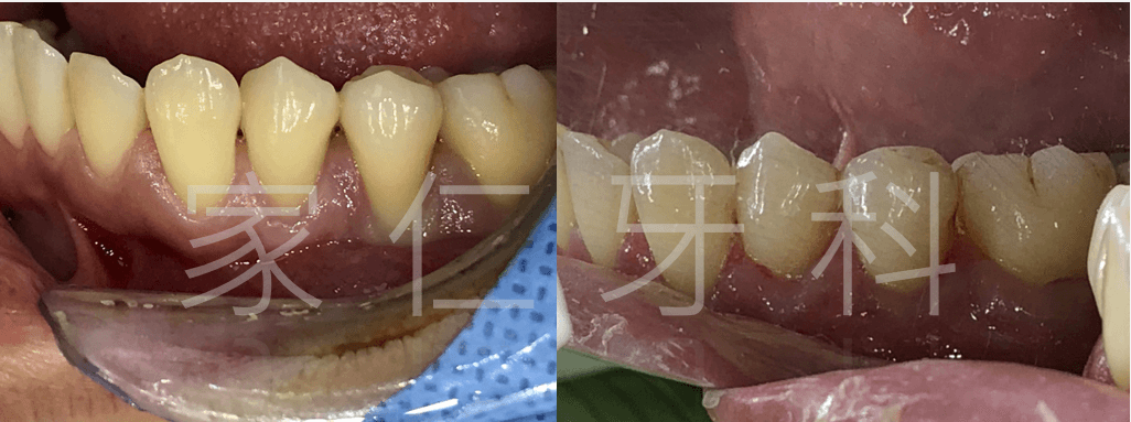 Gum graft surgery pre and post-op comparison to regenerate receded gums.