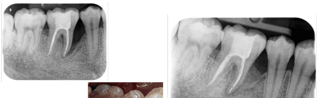 Pre and post-op X-ray comparison showing bone regeneration after regenerative surgery