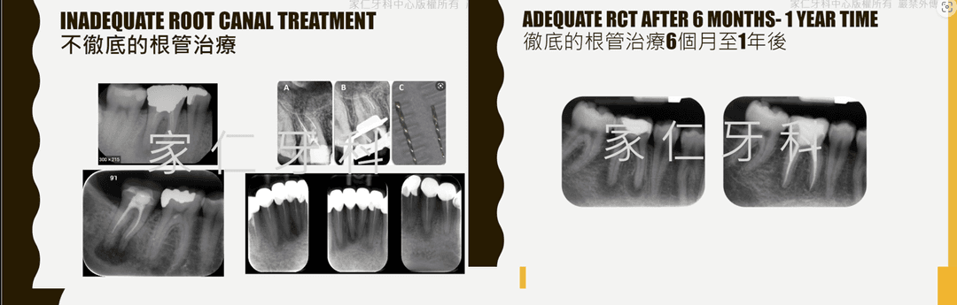 展示不徹底的根管治療失敗及再次治療結果的照片，顯示成功的根管再治療後，隨著時間的推移，透射性病變區域被骨組織修復