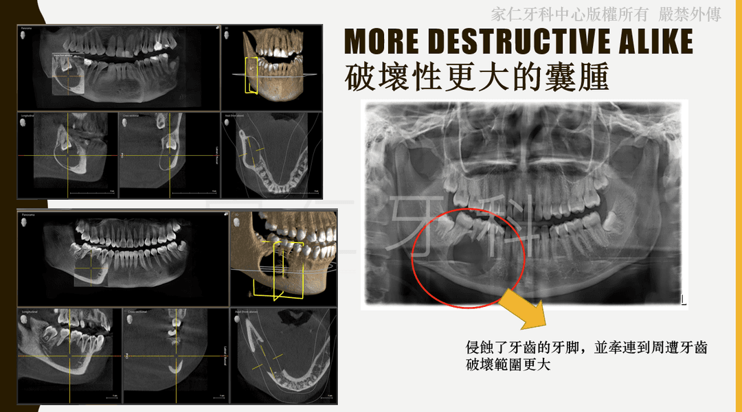 顯示牙齒膿腫如果未經治療，會發展成囊腫的影像，包含CT掃描和X光片，顯示破壞性更大的囊腫侵蝕了牙齒的牙腳，並蔓延到周邊牙齒，導致需要進行侵入性手術