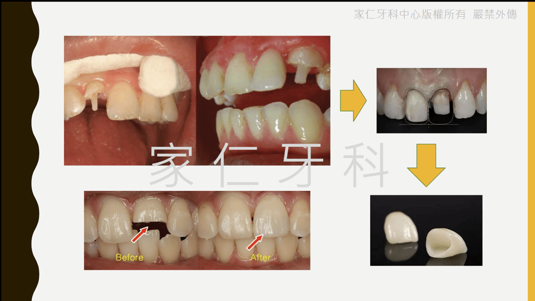 斷裂門牙的根管治療、樁核和牙冠修復，顯示功能和美觀效果的治療前後對比照片