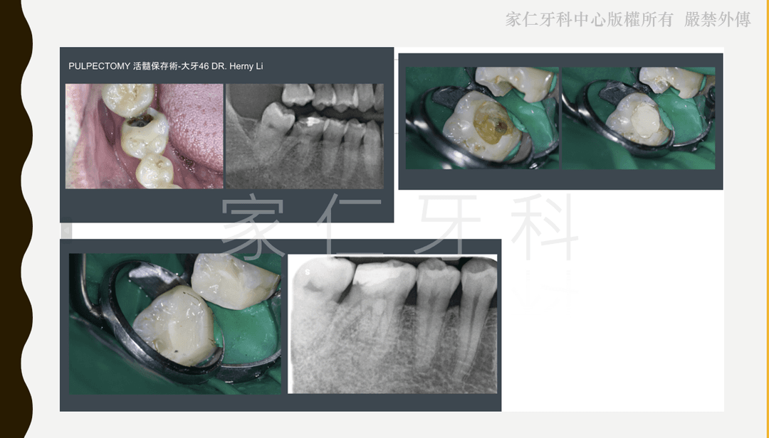 活髓保存術示範，展示使用特殊技術和材料保留健康牙髓部分的技術