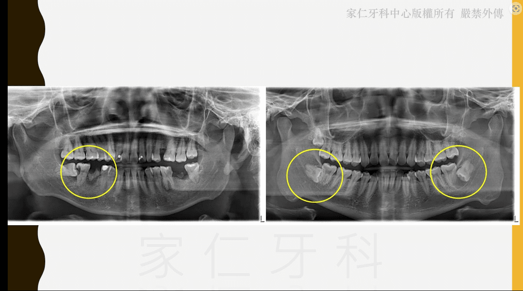 Demonstration of impacted wisdom teeth adversely affecting oral health, with the left causing caries in the molar in front and the right forming a cyst