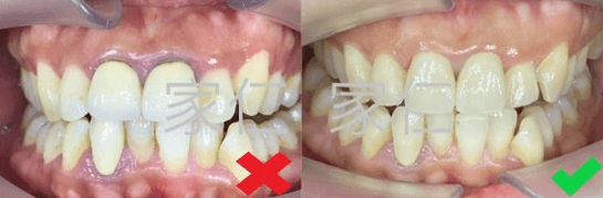 Left photo shows an unfit and unaesthetic crown causing bacteria trap, dental caries, and gum problems. Right photo shows a new crown providing a more aesthetic and healthy long-term conditio