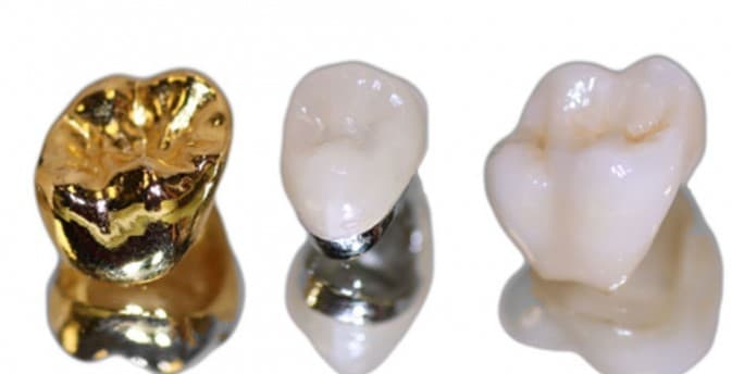 Image showing three types of dental crowns with different designs and materials for various advantages and case scenarios: the left crown is a gold crown, the middle crown is a cerametal crown with metal underneath and porcelain added, and the right crown is a pure porcelain crown