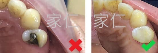 比較一顆牙齒的舊填充物漏水（左側）和新的牙齒嵌體以獲得更好的邊緣密合和更高強度（右側）