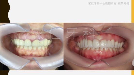 dental veneer