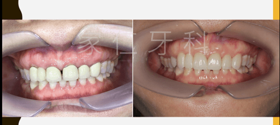 dental bridge