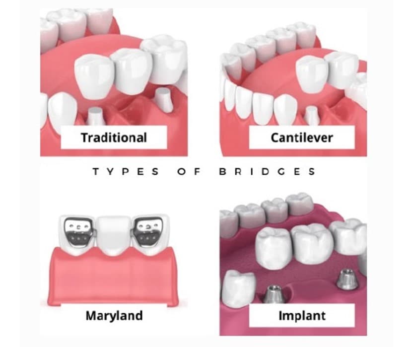 dental bridge